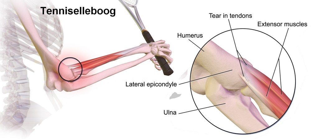 Tennisarm of tenniselleboog